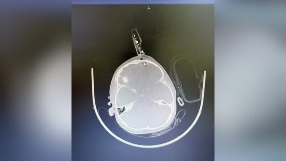 Criança De 01 Ano Cai Da Cama Tem Carregador Cravado Na Testa E Passa